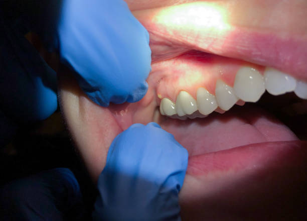 Best Emergency Dental Care for Broken or Chipped Teeth in Rochester Institute Of Technology, NY